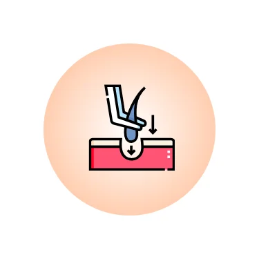 Acne Treatment